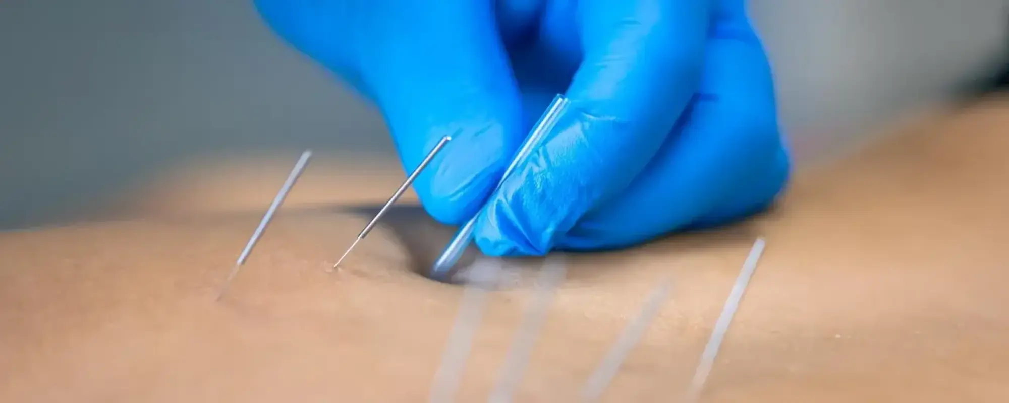 close-up-needle-hands-physiotherapist-doing-dry-needling_169016-48344 (1) (1)